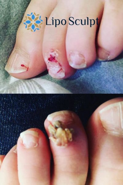 Wart removal customer results from Lipo Sculpt Norwich
